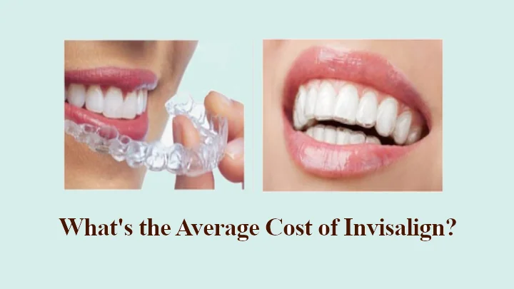 What's the Average Cost of Invisalign
