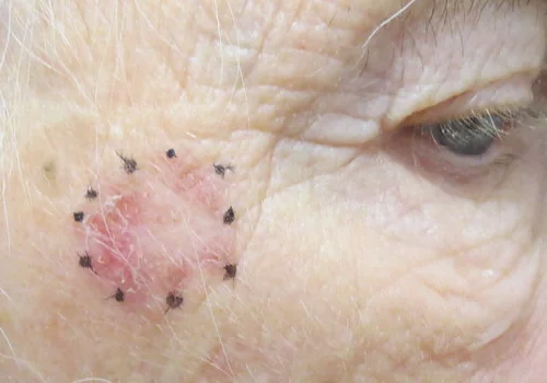 skin cancer looks like a pimple