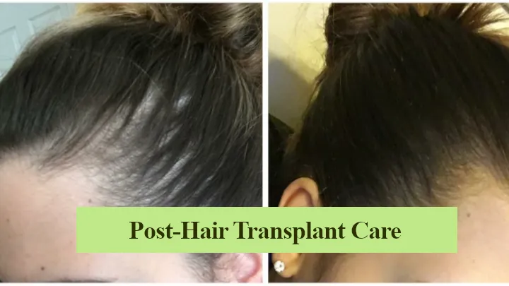 post hair transplant Care