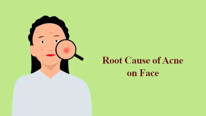 root cause of acne on face