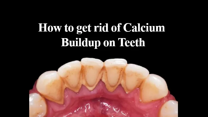 How to get rid of Calcium Buildup on Teeth