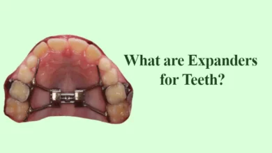What are Expanders for Teeth