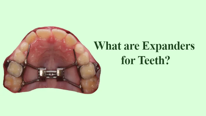 What are Expanders for Teeth