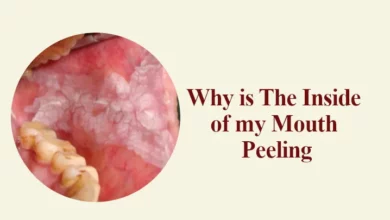 Mouth inside Peeling