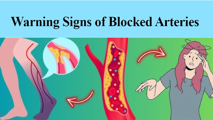 Warning Signs of Blocked Arteries