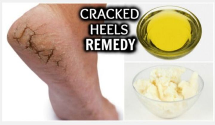 10 Best And Effective Home Remedies For Cracked Heels - Right Home Remedies