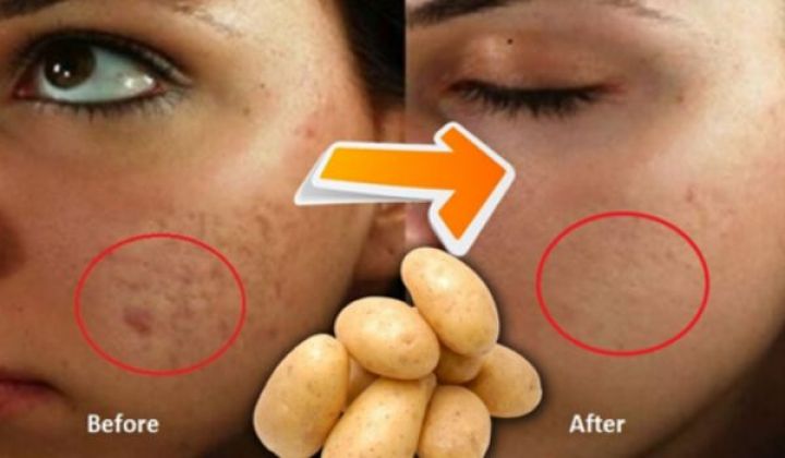 How to Remove Dark Spots on Face with 10 Home Remedies