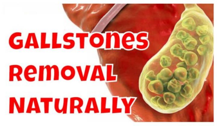 Stone in gallbladder surgery