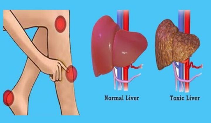 10 Warning Signs Your Liver is Full of Toxins - Right Home Remedies