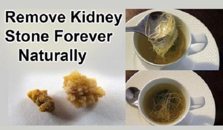 Without Surgery How to Pass a Kidney Stone Forever in 24 hours (100% Working) Without Surgery How to Pass a Kidney Stone Forever in 24 hours (100% Working)