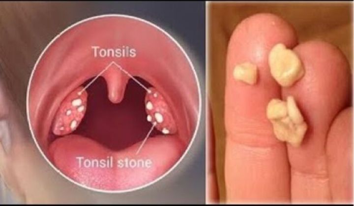 Does Scarlet Fever Cause Swollen Tonsils