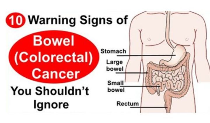 10 Warning Signs Of Colon Cancer You Shouldnt Ignore Right Home Remedies 6385